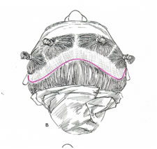 lifting coronal antiguo