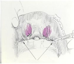 lifting coronal antiguo