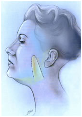 lifting facial