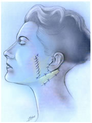 lifting facial