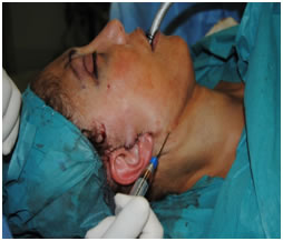 Lifting facial