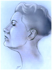 lifting facial
