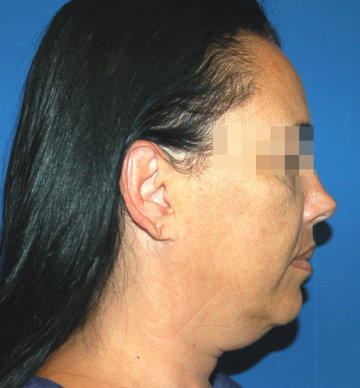 rejuvenecimiento facial