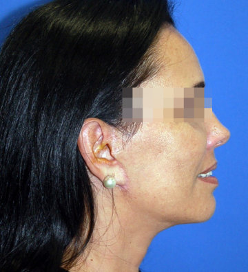 rejuvenecimiento facial