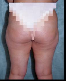 Lipoescultura