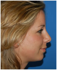rinoplastia